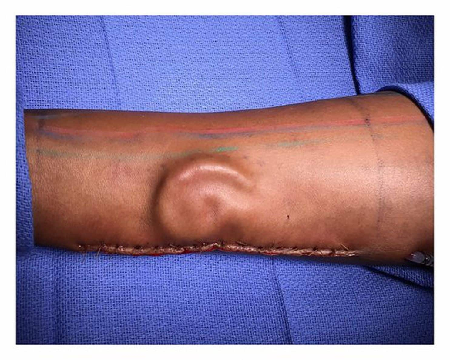 Army Doctors Grew a New Ear on the Arm of a Soldier in Need